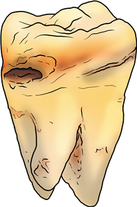 Rotten Tooth